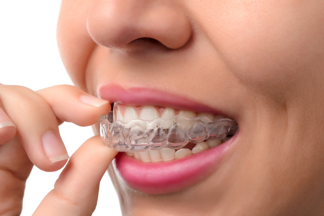 invisalign services